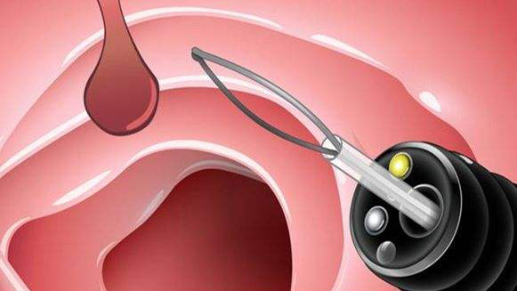 【健康解碼&middot;小貼士】檢查出息肉 需要切除嗎？